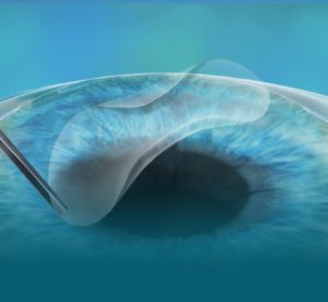 what i wish i knew before lasik