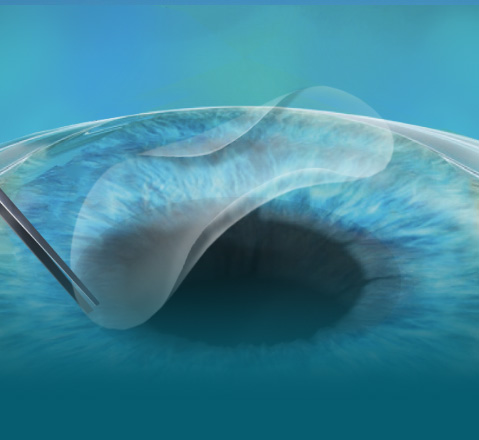 what i wish i knew before lasik