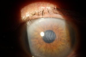Eyelid Swelling After LASIK Surgery