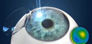 Person undergoing LASIK surgery with a droplet of water on their eye
