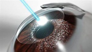 A comparison of Lasik and cataract surgery procedures.