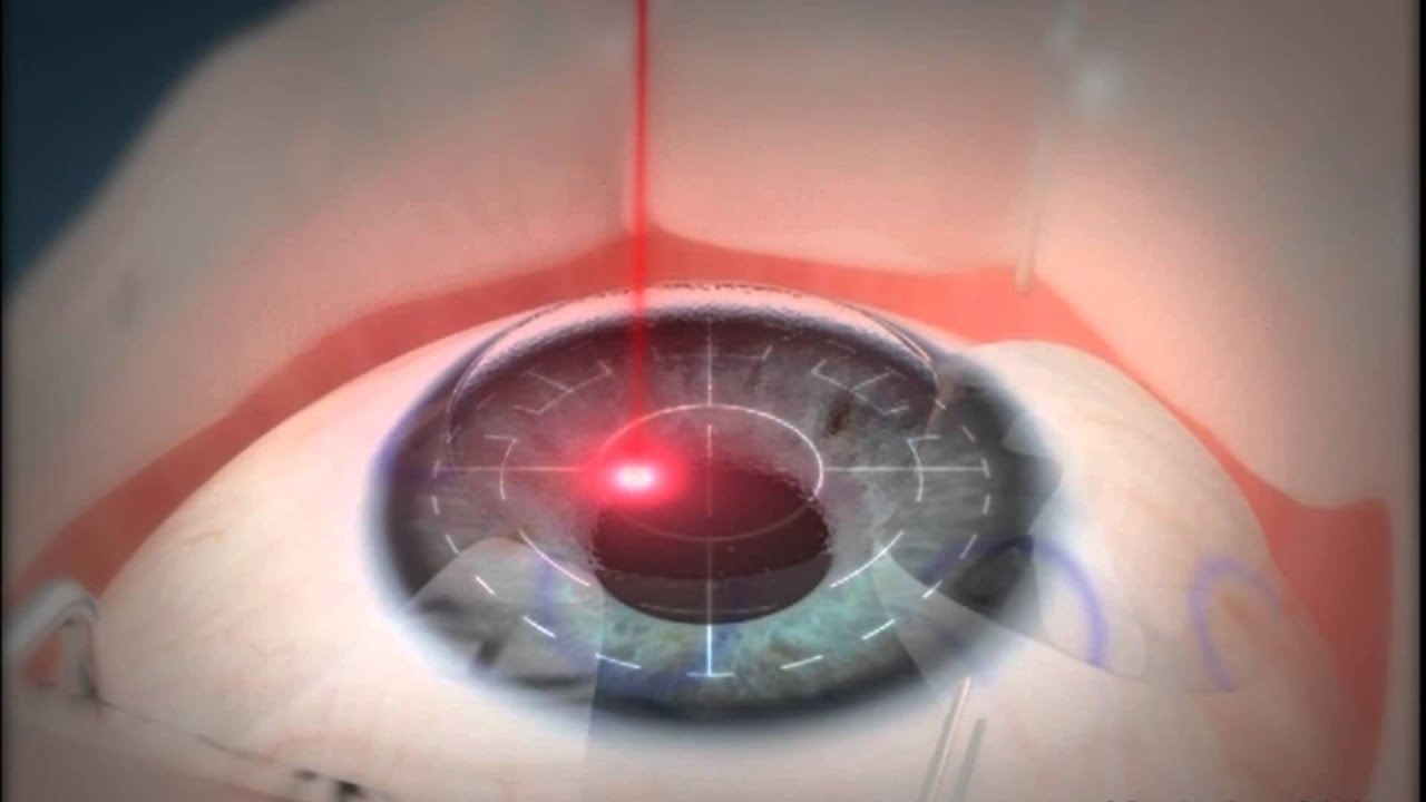 What is the Maximum Prescription for Lasik?