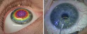 Corneal Remodeling After Lasik Eye Surgery?