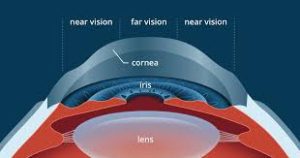Correcting Presbyopia After Lasik?