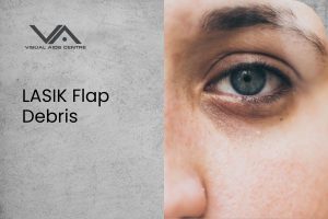 Dealing with Lasik Flap Debris: What You Need to Know