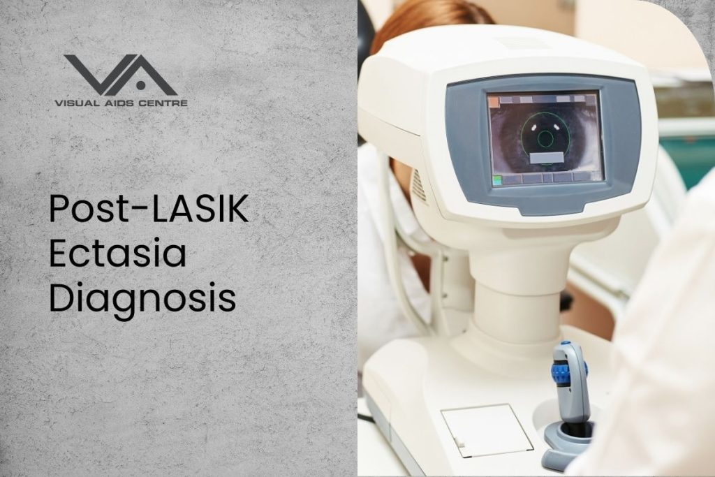 Post Lasik Ectasia Diagnosis
