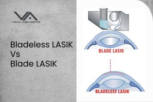 Bladeless Lasik vs Blade Lasik: Pros and Cons Explored