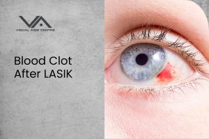 Blood Clot After LASIK: What You Need to Know