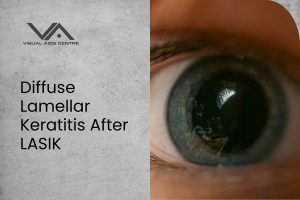 Diffuse Lamellar Keratitis After LASIK
